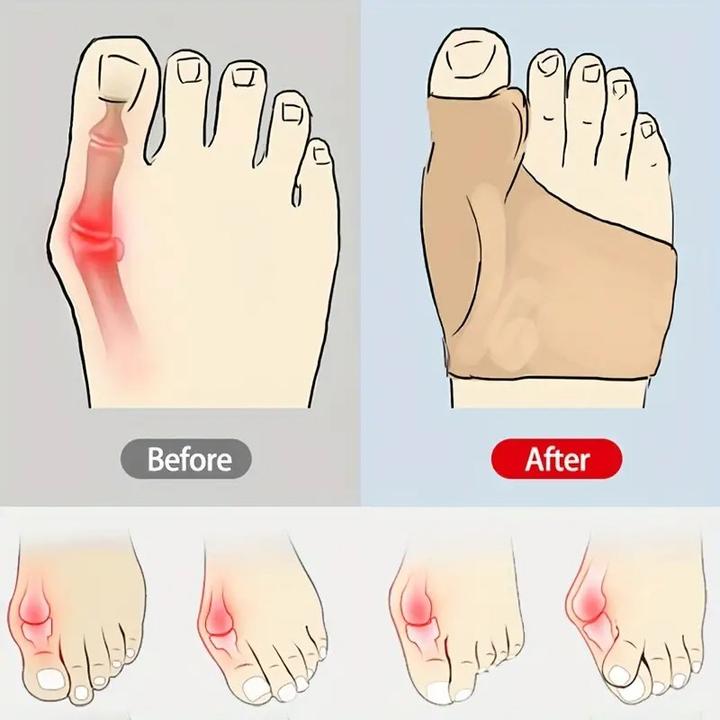 Immagine prodotto Cbx Benda per la correzione dell'alluce valgo con cuscinetto in silicone integrato 2 pezzi (Crema piedi e gel piedi)