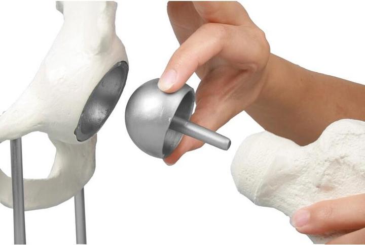 Immagine prodotto Erler Zimmer Articolazione dell'anca con protesi a coppa