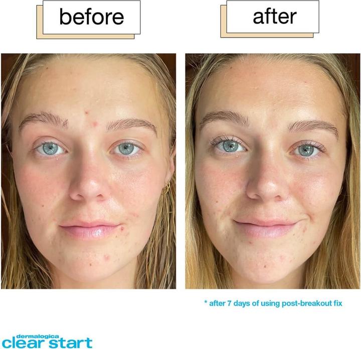 Image du produit Dermalogica Clear Start - Correction post-rupture (Crème pour le corps, 15 ml)
