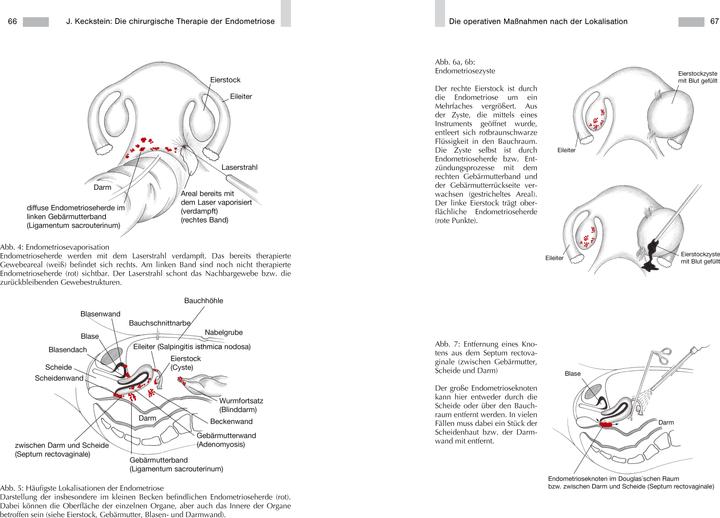 Image du produit Endometriose - Die verkannte Frauenkrankheit (Allemand, Joanna Wolf, Prof. Jörg Keckstein, docteur en médecine, Dr Anja Maria Engelsing, Professeur Gerhard Leyendecker, 2019)