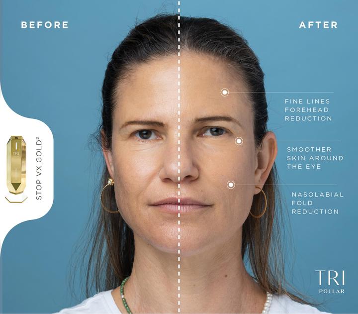 Produktbild TriPollar VX Gold2 ultimative Haut-Pflege anti ageing RF-DMA
