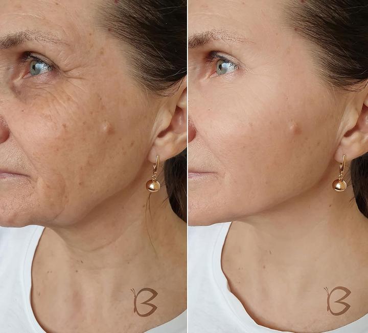 Actual product image Beautifly B Meso
