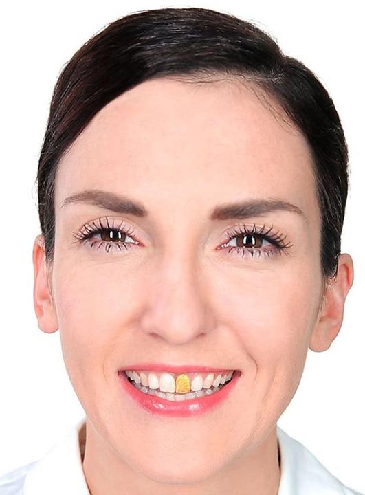 Actual product image Metamorph Dental gold
