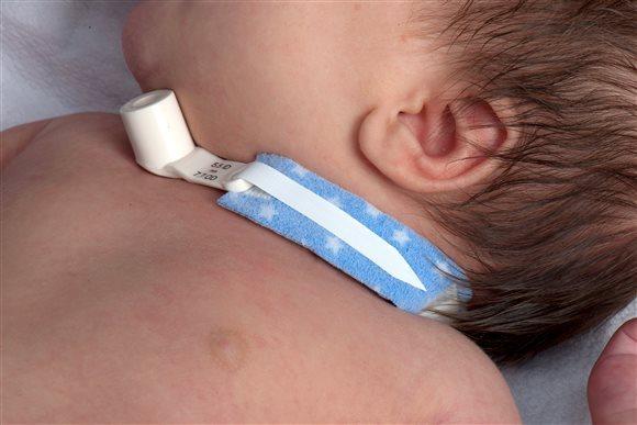 Dale Tracheostomy Tube Holder Kleinkinder 242 10 Stk