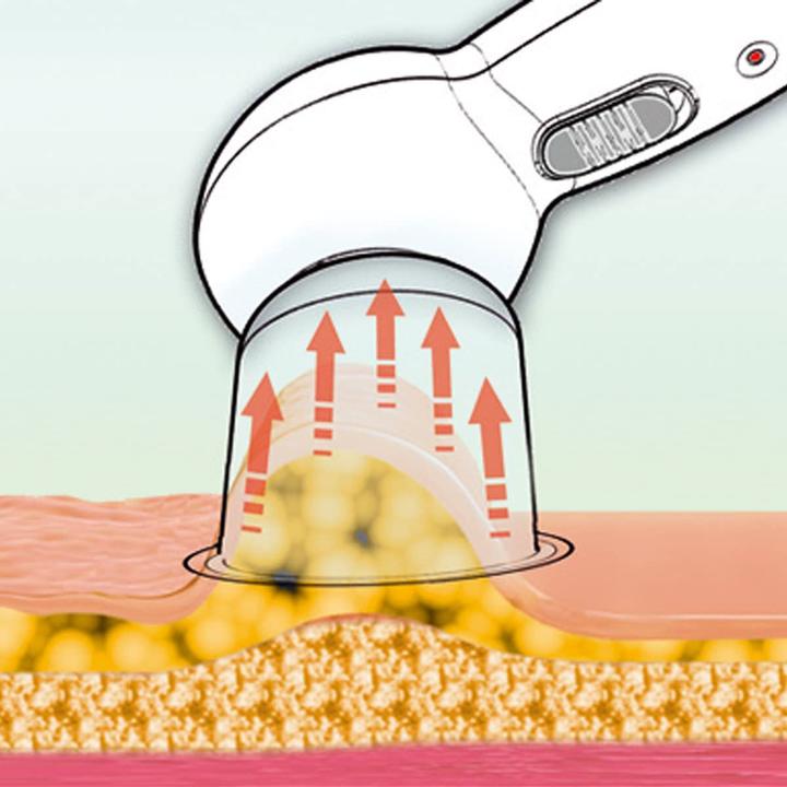 Actual product image Prorelax Vacuum massager