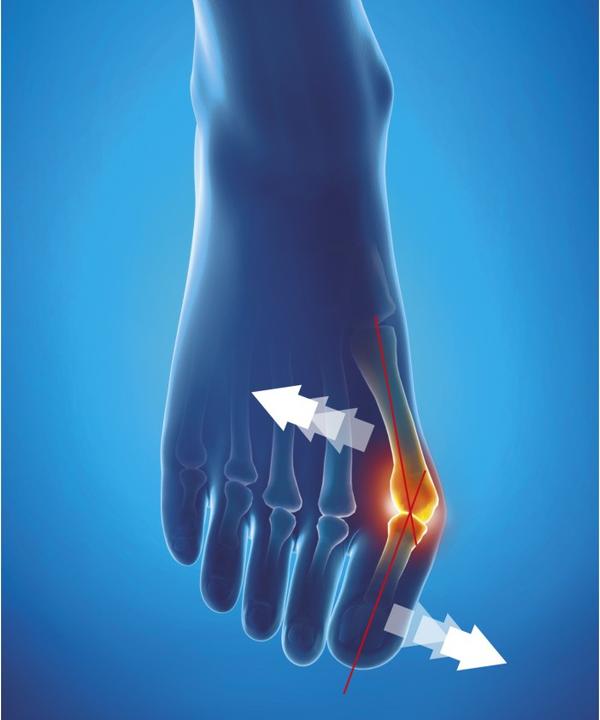 Produktbild Epitact flexible Korrekturbandage Hallux valgus TAG L 23-24.5cm (L)
