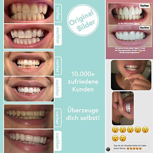 Produktbild UniqueSmile Teeth Whitening (Kit)