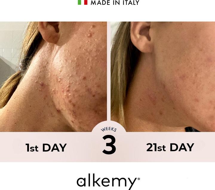 Immagine prodotto Alkemy Crema Anti Brufoli e Imperfezioni - Cosmetica Naturale - Trattamento Acne (Crema 24h)