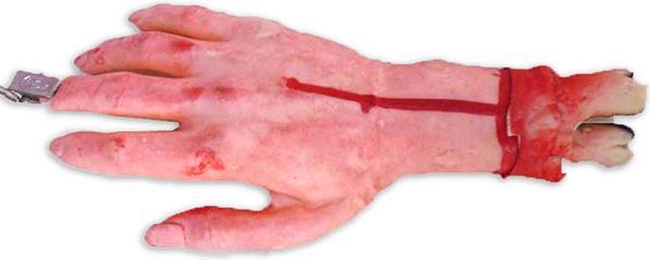 Actual product image Erfurth Bleeding hand