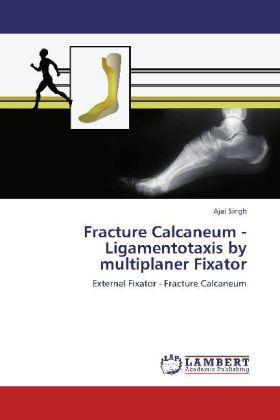 Actual product image Fracture Calcaneum - Ligamentotaxis by multiplaner Fixator (Ajai Singh, 2012)