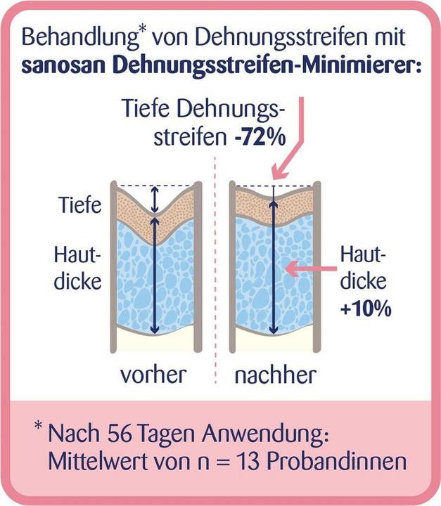 Produktbild Sanosan Dehnungsstreifen Minimierer