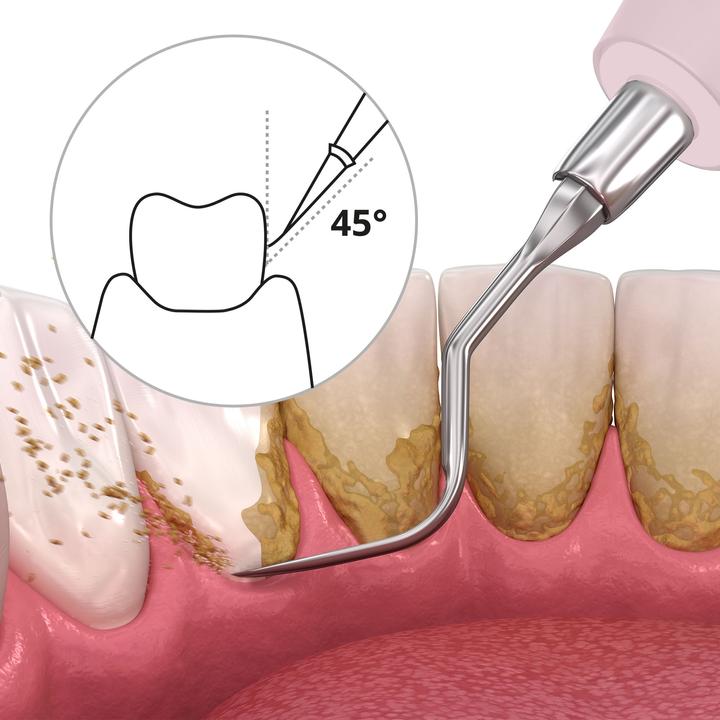 Actual product image Ailoria Deplaqued (Sonic tooth cleaner)