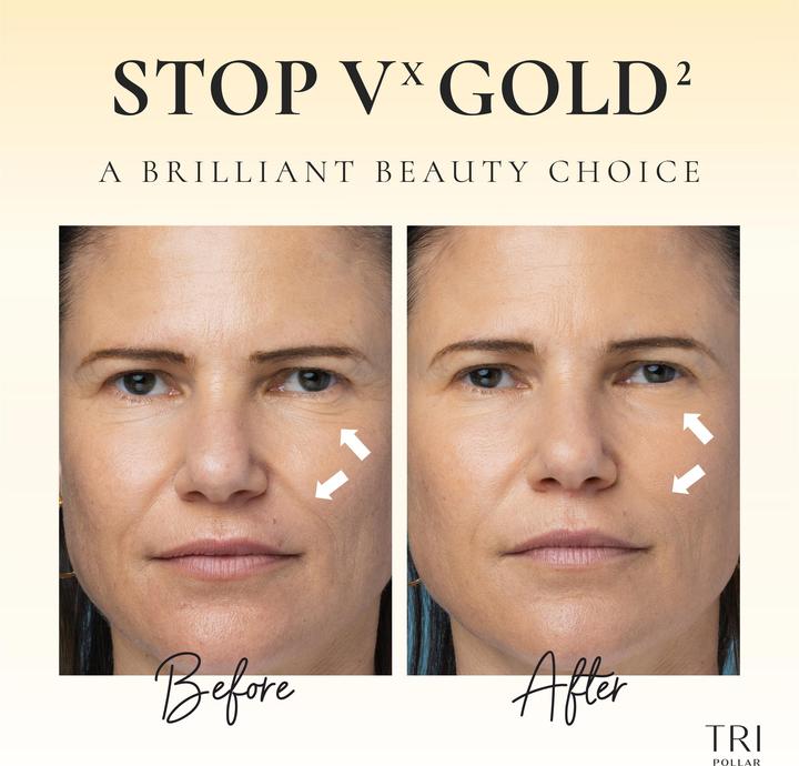 Produktbild TriPollar VX Gold2 ultimative Haut-Pflege anti ageing RF-DMA