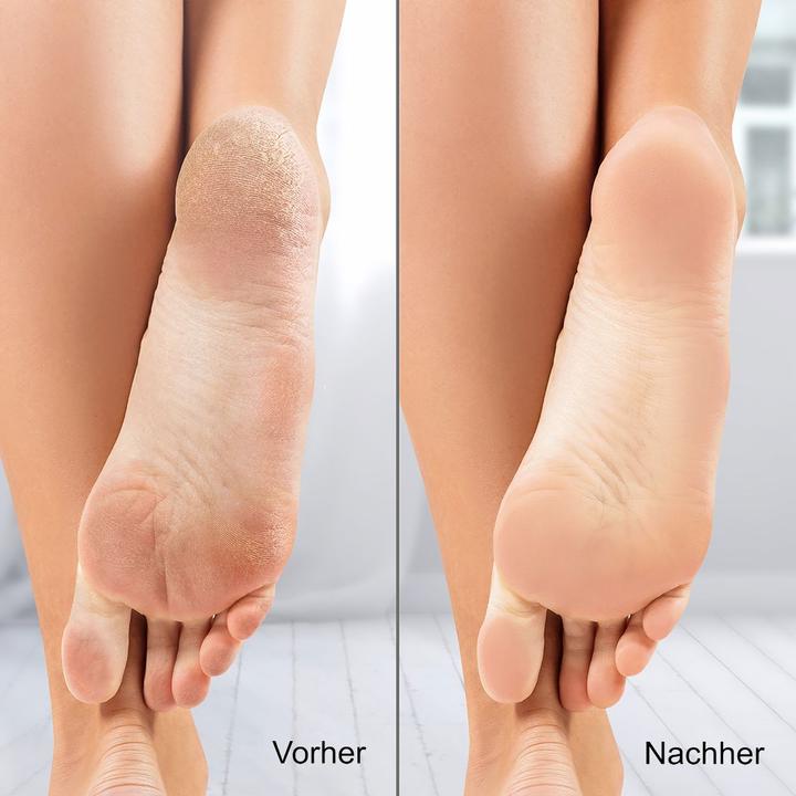 Produktbild Silk'n VacuPedi black