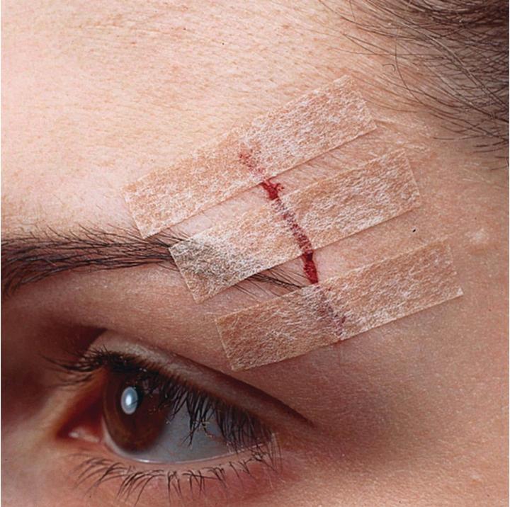 Actual product image Nexcare Steri-Strip wound closure strips (6 x)