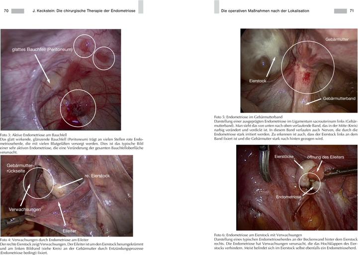 Image du produit Endometriose - Die verkannte Frauenkrankheit (Allemand, Joanna Wolf, Prof. Jörg Keckstein, docteur en médecine, Dr Anja Maria Engelsing, Professeur Gerhard Leyendecker, 2019)
