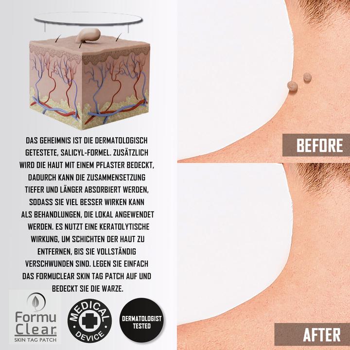 Produktbild Formu Clear Skin Tag Patch (Fussdeodorant & -puder)