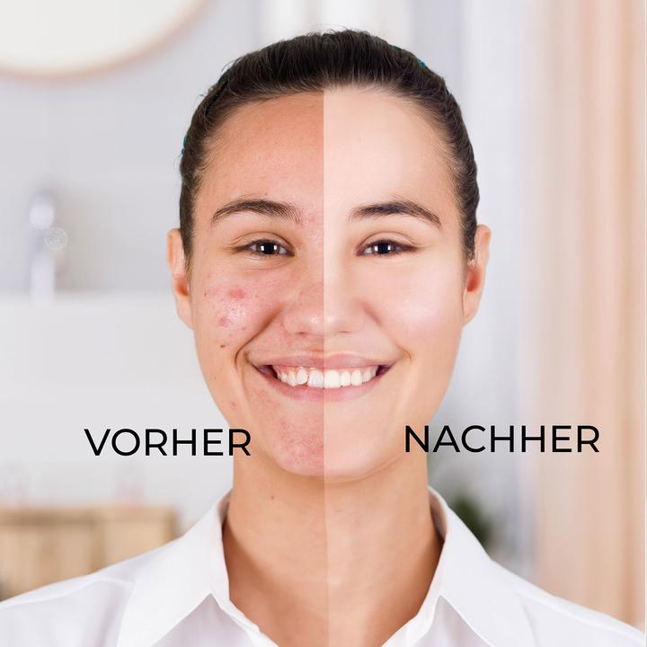 Produktbild Hermex Mitesserentferner Gesichtspflege (Mitesserentferner)