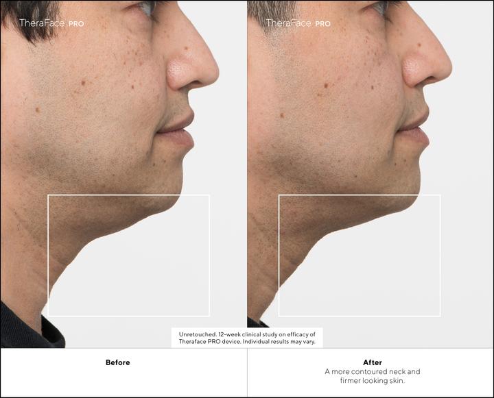 Actual product image Therabody TheraFace Pro