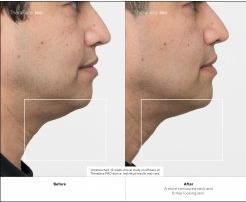 Actual product image Therabody TheraFace Pro