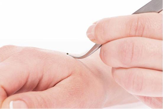 Actual product image Canal instrumente Tick tweezers curved